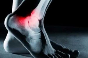 Plantar Fasciitis - Heel Pain