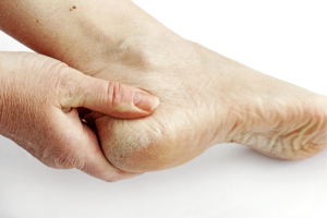 Dry Heels With Hyperkeratosis